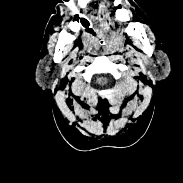 Basilar artery thrombosis (Radiopaedia 53351-59352 Axial non-contrast 6).jpg