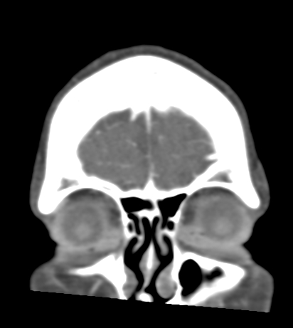 Basilar tip aneurysm with coiling (Radiopaedia 53912-60086 B 8).jpg