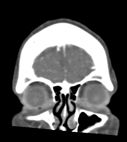 Basilar tip aneurysm with coiling (Radiopaedia 53912-60086 B 9).jpg