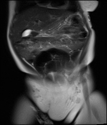 File:Beckwith-Wiedeman syndrome with bilateral Wilms tumors (Radiopaedia 60850-69233 Coronal T2 7).jpg