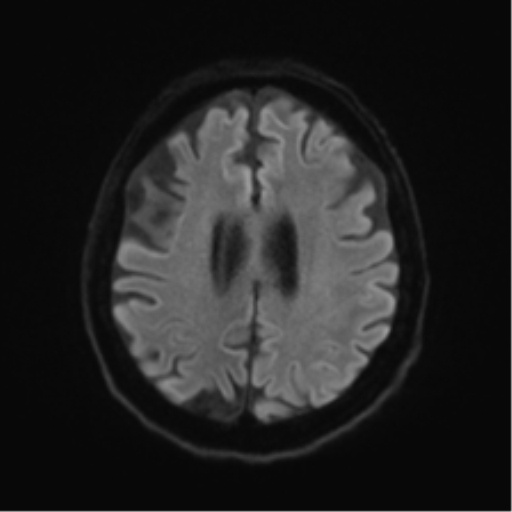 Behavioral variant frontotemporal dementia and late onset schizophrenia (Radiopaedia 52197-58083 Axial DTI Trace W 45).png