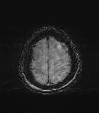 File:Behavioral variant frontotemporal dementia and late onset schizophrenia (Radiopaedia 52197-58083 Axial SWI 71).png