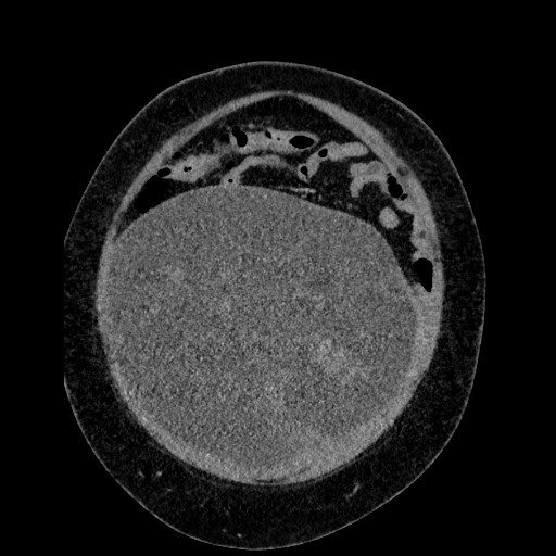 File:Benign leiomyoma with hydropic features (Radiopaedia 89250-106130 B 28).jpg