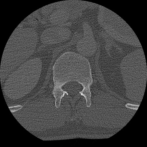 Benign post-traumatic pseudopneumoperitoneum (Radiopaedia 71199-81495 Axial bone window 176).jpg