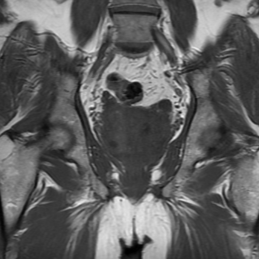 File:Benign prostatic nodular hyperplasia (Radiopaedia 16917-16634 Coronal T1 13).jpg