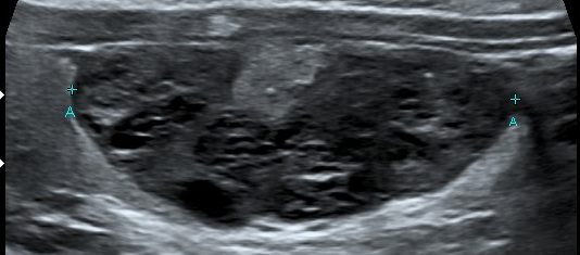 File:Benign thyroid lesions (Radiopaedia 21887-21858 A 1).png