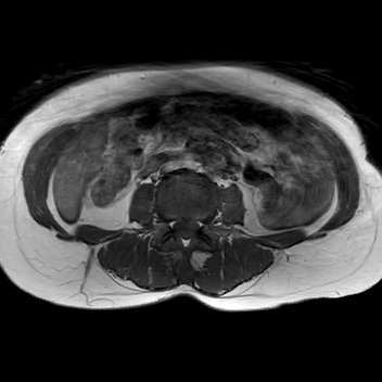 File:Bicornuate uterus (Radiopaedia 61974-70046 Axial T1 6).jpg
