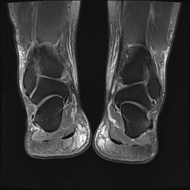 File:Bilateral Achilles tendon complete tear (Radiopaedia 81344-95051 Coronal PD fat sat 8).jpg
