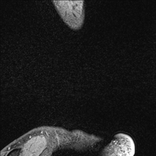 File:Bilateral Achilles tendon complete tear (Radiopaedia 81344-95051 Sagittal WE - Left 12).jpg