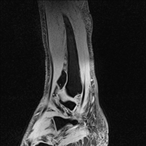 Bilateral Achilles tendon complete tear (Radiopaedia 81344-95051 Sagittal WE - Left 88).jpg