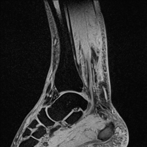 Bilateral Achilles tendon complete tear (Radiopaedia 81344-95051 Sagittal WE - Right 68).jpg