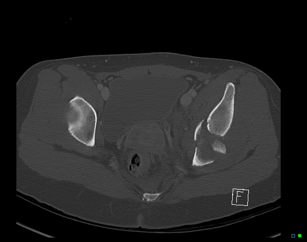 Bilateral acetabular fractures (Radiopaedia 79272-92308 Axial bone window 40).jpg