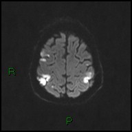 File:Bilateral acute middle cerebral artery territory infarcts (Radiopaedia 77319-89402 Axial DWI 44).jpg