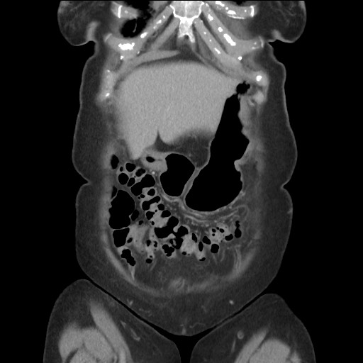 Bilateral adrenal granulocytic sarcomas (chloromas) (Radiopaedia 78375-91007 B 22).jpg