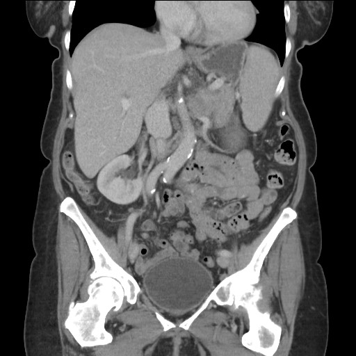 Bilateral adrenal granulocytic sarcomas (chloromas) (Radiopaedia 78375-91007 B 45).jpg
