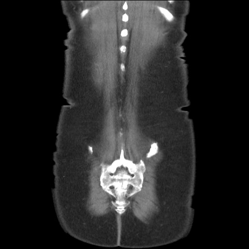 Bilateral adrenal granulocytic sarcomas (chloromas) (Radiopaedia 78375-91007 B 85).jpg