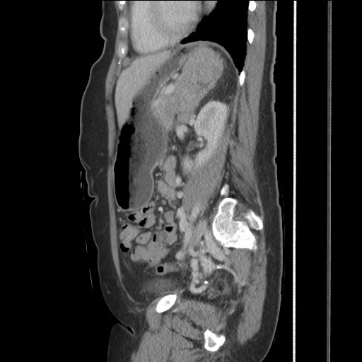 Bilateral adrenal granulocytic sarcomas (chloromas) (Radiopaedia 78375-91007 C 90).jpg