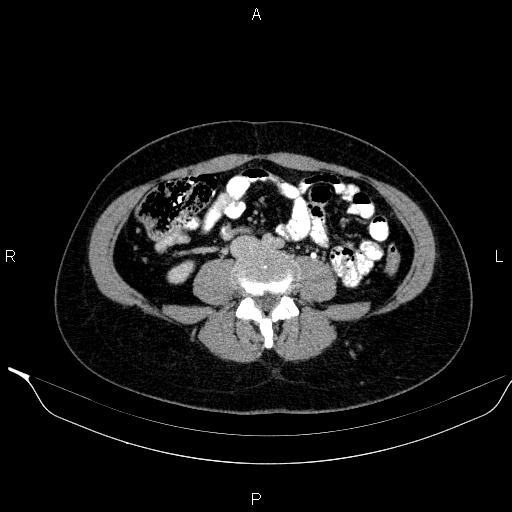 Bilateral adrenal myelolipoma (Radiopaedia 63058-71535 Axial C+ delayed 86).jpg