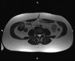 File:Bilateral adrenal myelolipoma (Radiopaedia 63058-71537 Axial T2 27).jpg