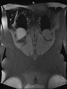 Bilateral adrenal myelolipoma (Radiopaedia 63058-71537 Coronal T1 fat sat 13).jpg