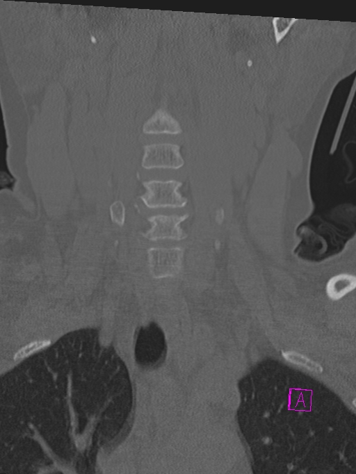 Bilateral atlanto-occipital assimilation (Radiopaedia 28350-28603 Coronal bone window 8).jpg