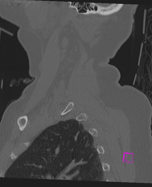 Bilateral atlanto-occipital assimilation (Radiopaedia 28350-28603 Sagittal bone window 69).jpg
