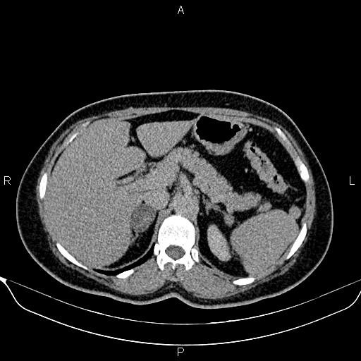 File:Bilateral benign adrenal adenomas (Radiopaedia 86912-103124 Axial C+ delayed 30).jpg