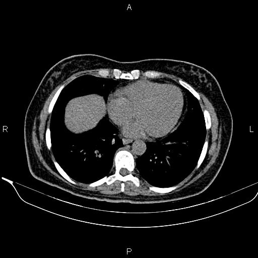 Bilateral benign adrenal adenomas (Radiopaedia 86912-103124 Axial non-contrast 10).jpg