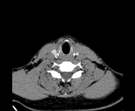 Bilateral carotid body tumors (Radiopaedia 61841-69870 Axial non-contrast 81).jpg
