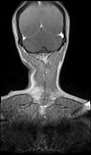 File:Bilateral carotid body tumors and right glomus jugulare tumor (Radiopaedia 20024-20060 MRA 70).jpg