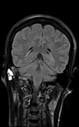 File:Bilateral carotid body tumors and right jugular paraganglioma (Radiopaedia 20024-20060 Coronal 56).jpg