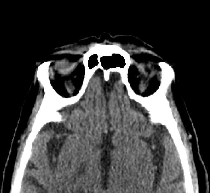 Bilateral ectopia lentis (Radiopaedia 89889-107013 Axial non-contrast 15).jpg
