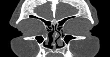 File:Bilateral ectopic infraorbital nerves (Radiopaedia 49006-54084 Coronal 59).png