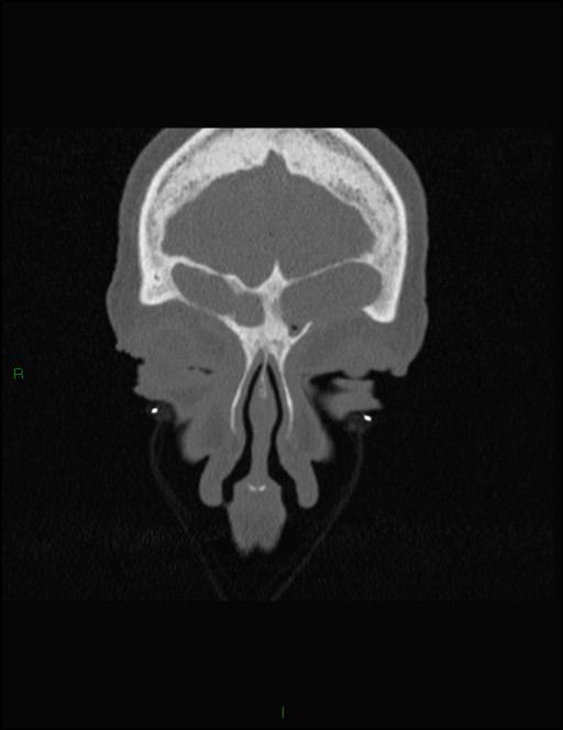 Bilateral frontal mucoceles (Radiopaedia 82352-96454 Coronal 62).jpg