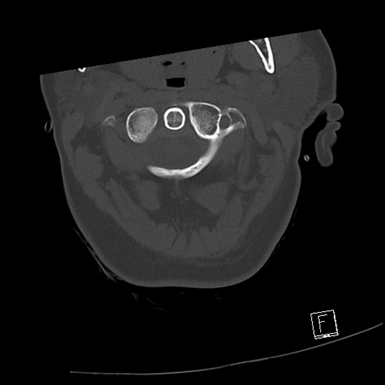 Bilateral occipital condyle fractures (type 3) (Radiopaedia 87672-104086 Axial bone window 18).jpg