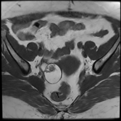 File:Bilateral ovarian dermoid cysts (Radiopaedia 90152-107338 Axial T1 9).jpg