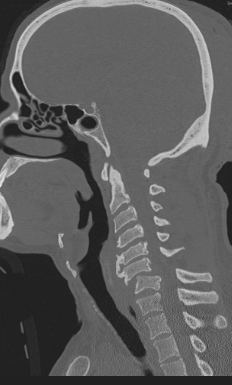 Bilateral perched facet joint (Radiopaedia 63149-71669 Sagittal bone window 32).jpg