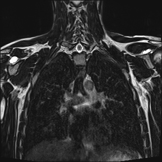 Bilateral spinoglenoid notch ganglion cysts (Radiopaedia 29577-30082 Coronal T2 72).jpg