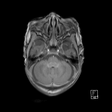 File:Bilateral subdural hemorrhage and parietal skull fracture (Radiopaedia 26058-26190 Axial T1 12).png