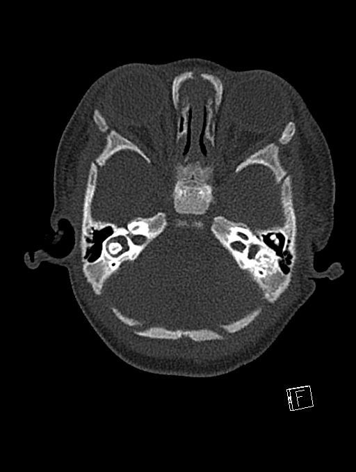 Bilateral subdural hemorrhage and parietal skull fracture (Radiopaedia 26058-26192 Axial bone window 106).png