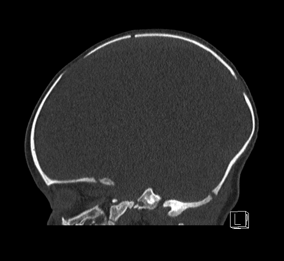 Bilateral subdural hemorrhage and parietal skull fracture (Radiopaedia 26058-26192 Sagittal bone window 61).png