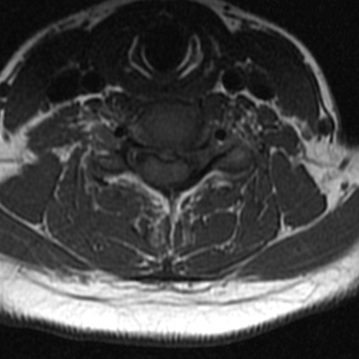 File:Bilateral tortuous vertebral arteries (Radiopaedia 19070-19039 Axial T2 4).jpg