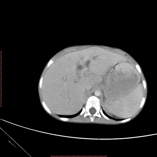 Biliary tract embryonal rhabdomyosarcoma (Radiopaedia 51815-57648 A 17).jpg
