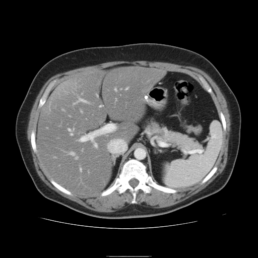 File:Billroth I gastric resection (Radiopaedia 17685-17425 None 9).jpg