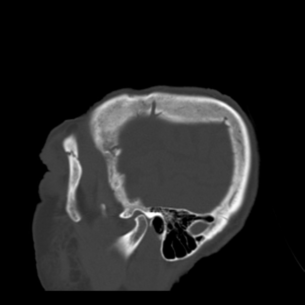 Biparietal osteodystrophy (Radiopaedia 46109-50463 Sagittal bone window 91).jpg