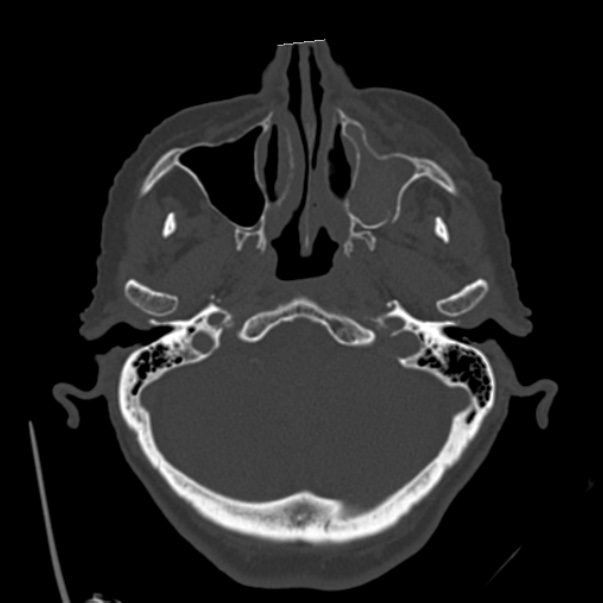 Biparietal osteodystrophy (Radiopaedia 46109-50463 bone window 15).jpg