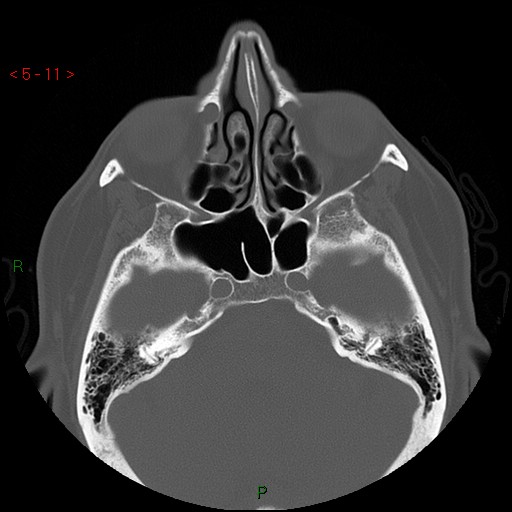 Bisphosphonate-related osteonecrosis of the jaw (Radiopaedia 54147-60329 Axial bone window 5).jpg