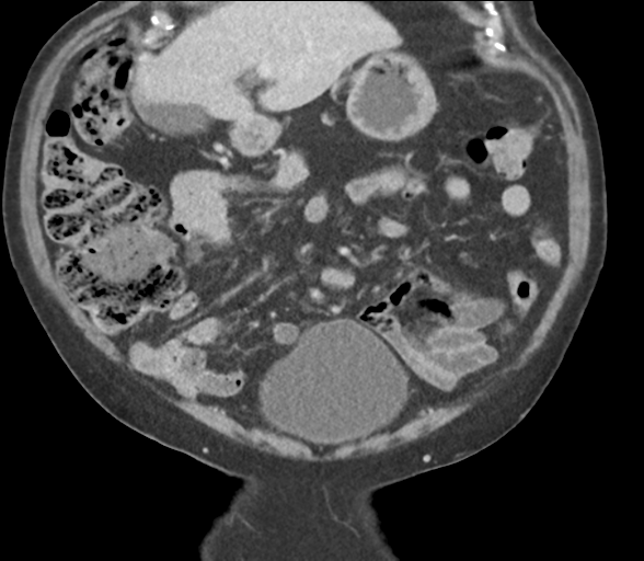 Bladder papillary urothelial carcinoma (Radiopaedia 48119-52951 C 23).png