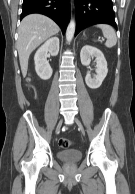 Bleeding duodenal ulcer and adenomyomatosis of gallbladder (Radiopaedia 61834-69861 B 33).jpg
