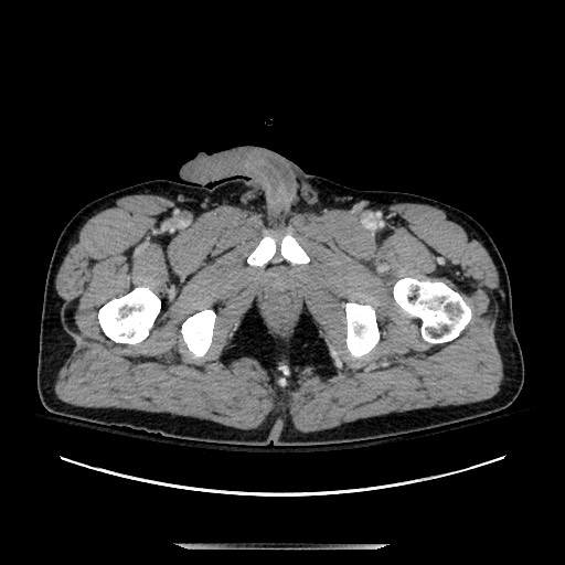 Blunt abdominal trauma with solid organ and musculoskelatal injury with active extravasation (Radiopaedia 68364-77895 A 162).jpg